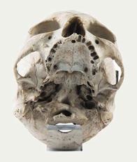 Cranio patologico