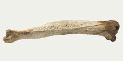 Reperti scheletrici, Tibia patologica