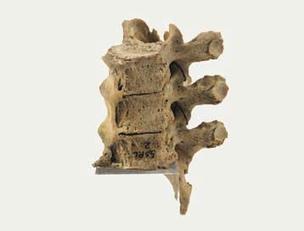 Reperti scheletrici, Vertebre toraciche patologiche