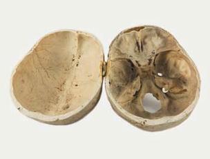 Reperti scheletrici, Cranio scalottato