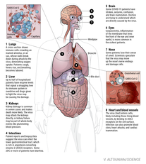 Una sindrome con un coinvolgimento multiorgano