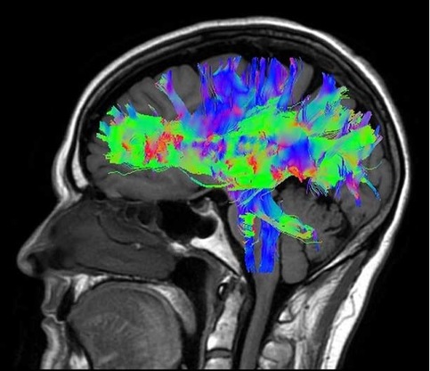 Immagine tridimensionale del cranio con taglio saggitale dell&rsquo;encefalo ottenuta con tecniche complementari, combinando radiazioni ionizzanti e campi magnetici, solo le prime presentano un rischio per il paziente